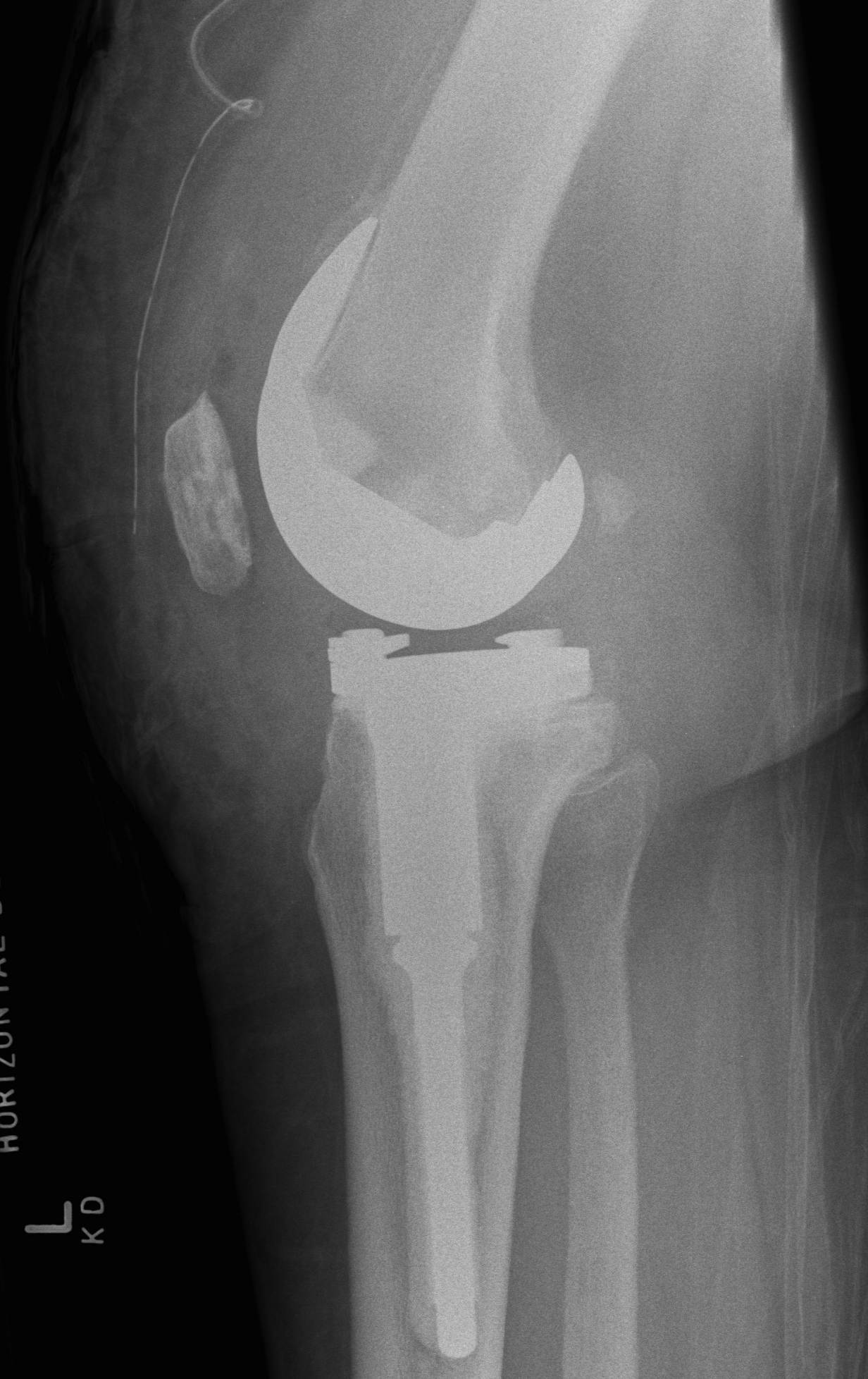 Revision TKR Type 1 Defect Lateral